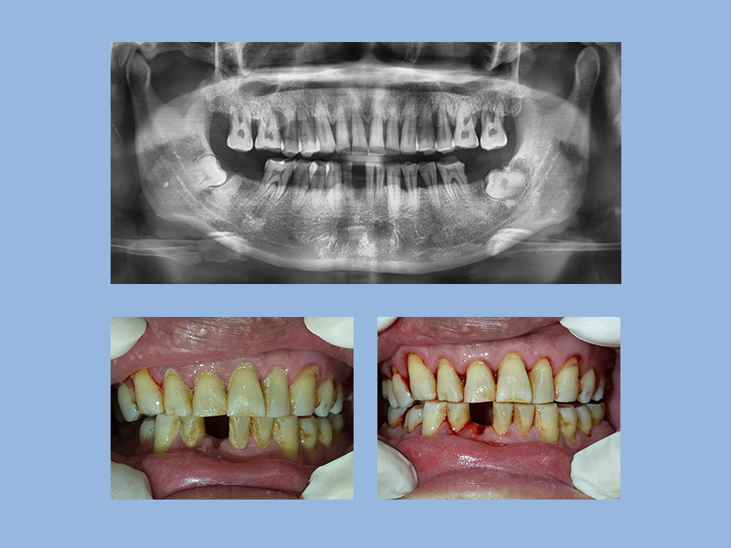 牙周病案例- 佳禾牙醫診所Joyful Dental Clinic